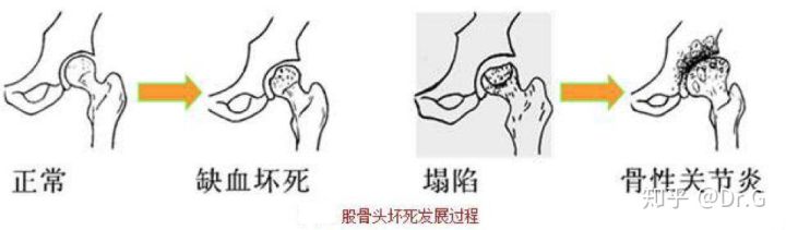 短时间用激素一定会股骨头坏死吗,没服过激素会股骨头坏死吗