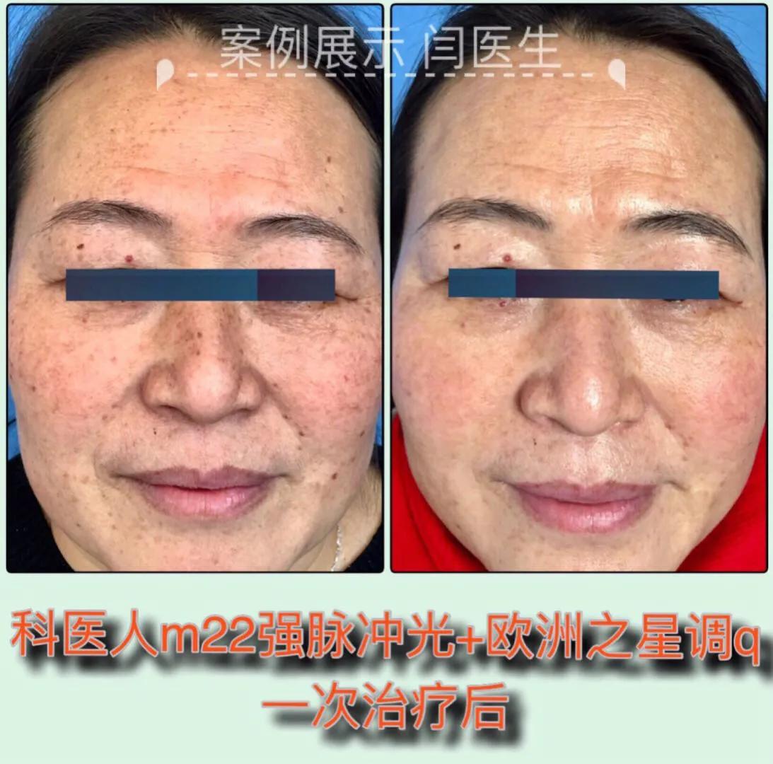 一次搞定雀斑的秘方绝招公开,长了雀斑很难看有一个小妙招