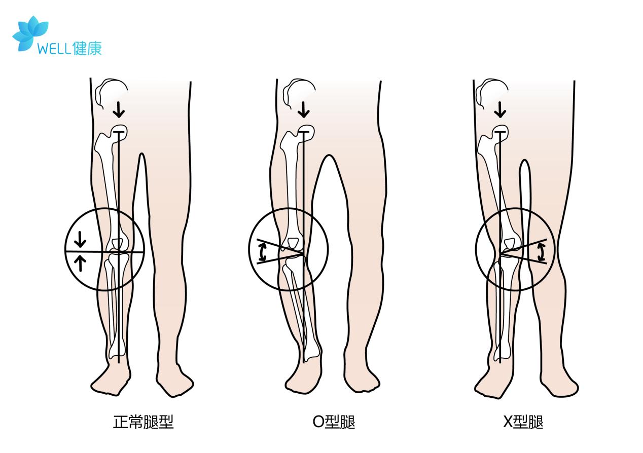 o型腿很丑怎么办,o型腿除了难看还有啥