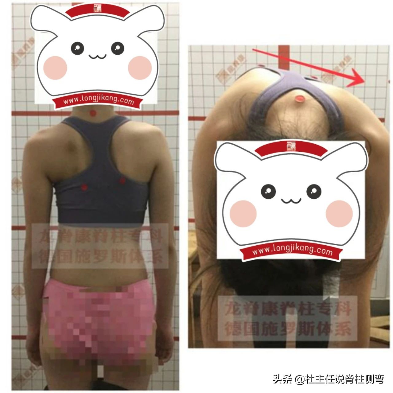 女孩17岁脊柱侧弯有加重现象,12岁女孩脊柱侧弯戴支具能恢复吗