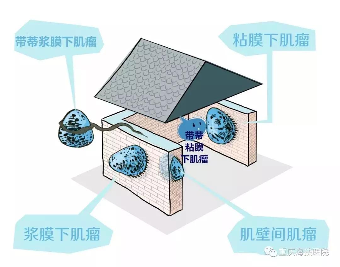 30岁未婚未育遇上子宫肌瘤该怎么办?