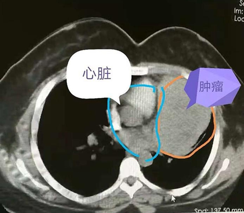 年纪大的恶性胸腺瘤建议做手术吗,30多岁胸腺瘤影响生命