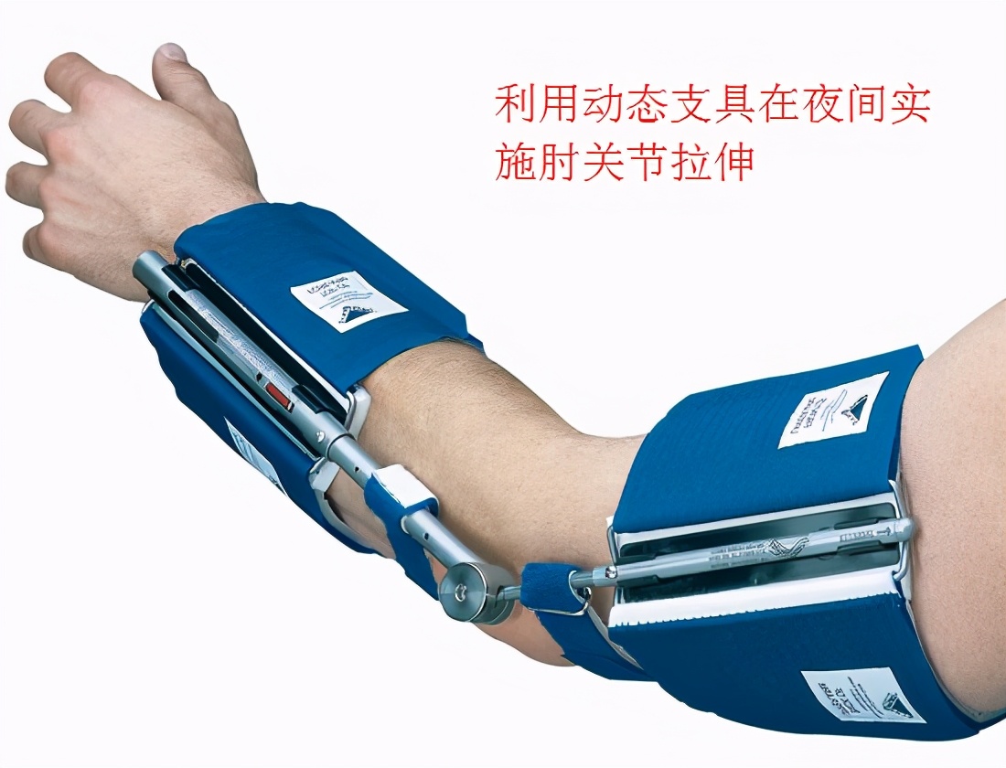 肘关节活动受限建议手术吗,肘关节钙化屈肘受限完全康复