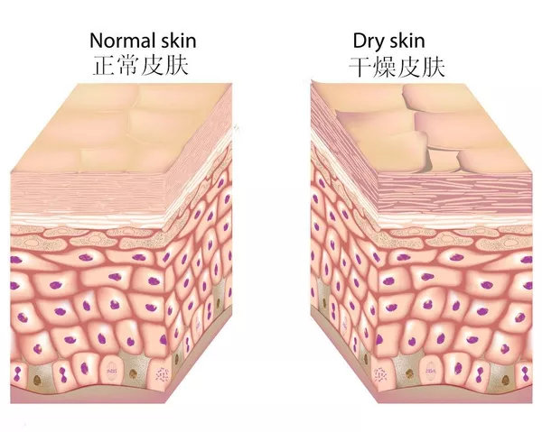 脸皮太干怎么能保湿,脸皮特别干用什么来修复