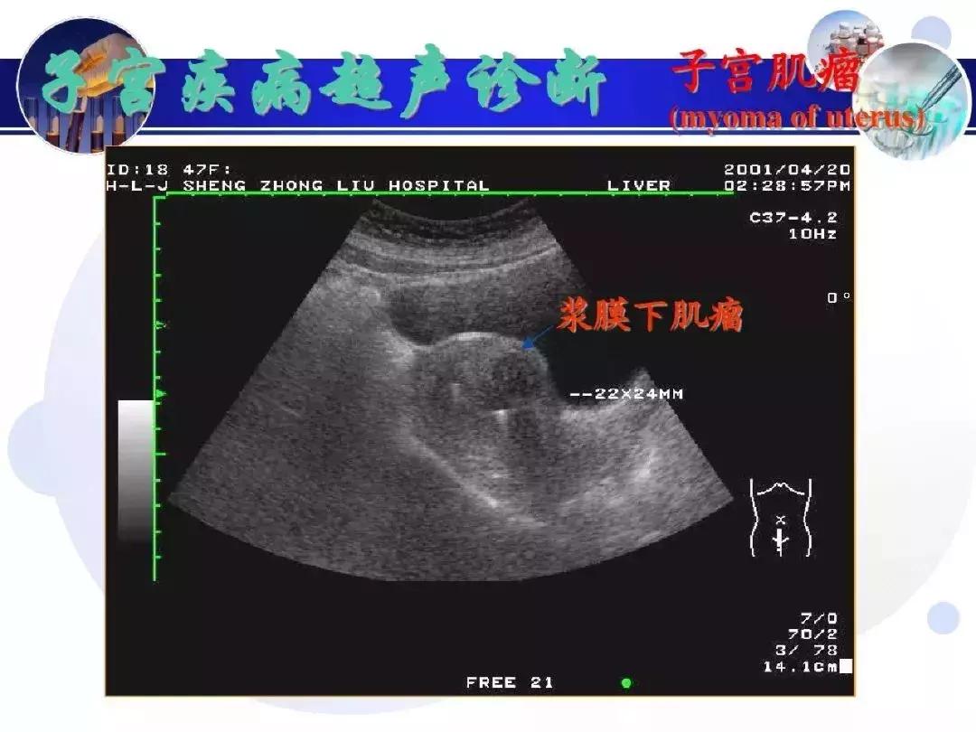纯干货！子宫及附件解剖和超声诊断