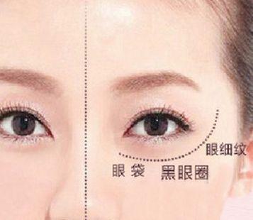 女人眼袋整容失败,30岁后女人去眼袋微整效果图