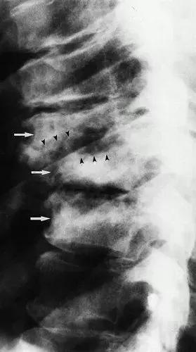神经性骨关节病,神经性关节炎症状图片