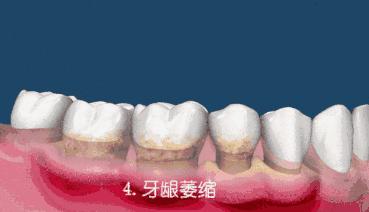 300洗牙贵吗,洗牙300和600元有什么区别