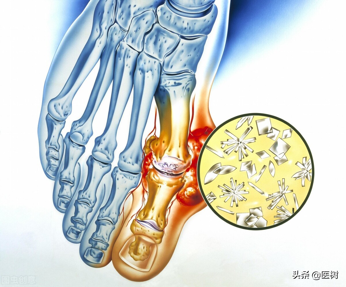 痛风肾衰竭预后怎么样,痛风并肾衰怎样治疗