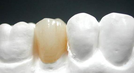 全瓷牙和烤瓷牙哪个更贵,全瓷牙比烤瓷牙哪个更容易崩瓷