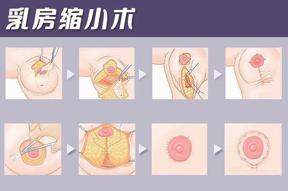 乳房太大?需要做巨乳缩小手术吗?