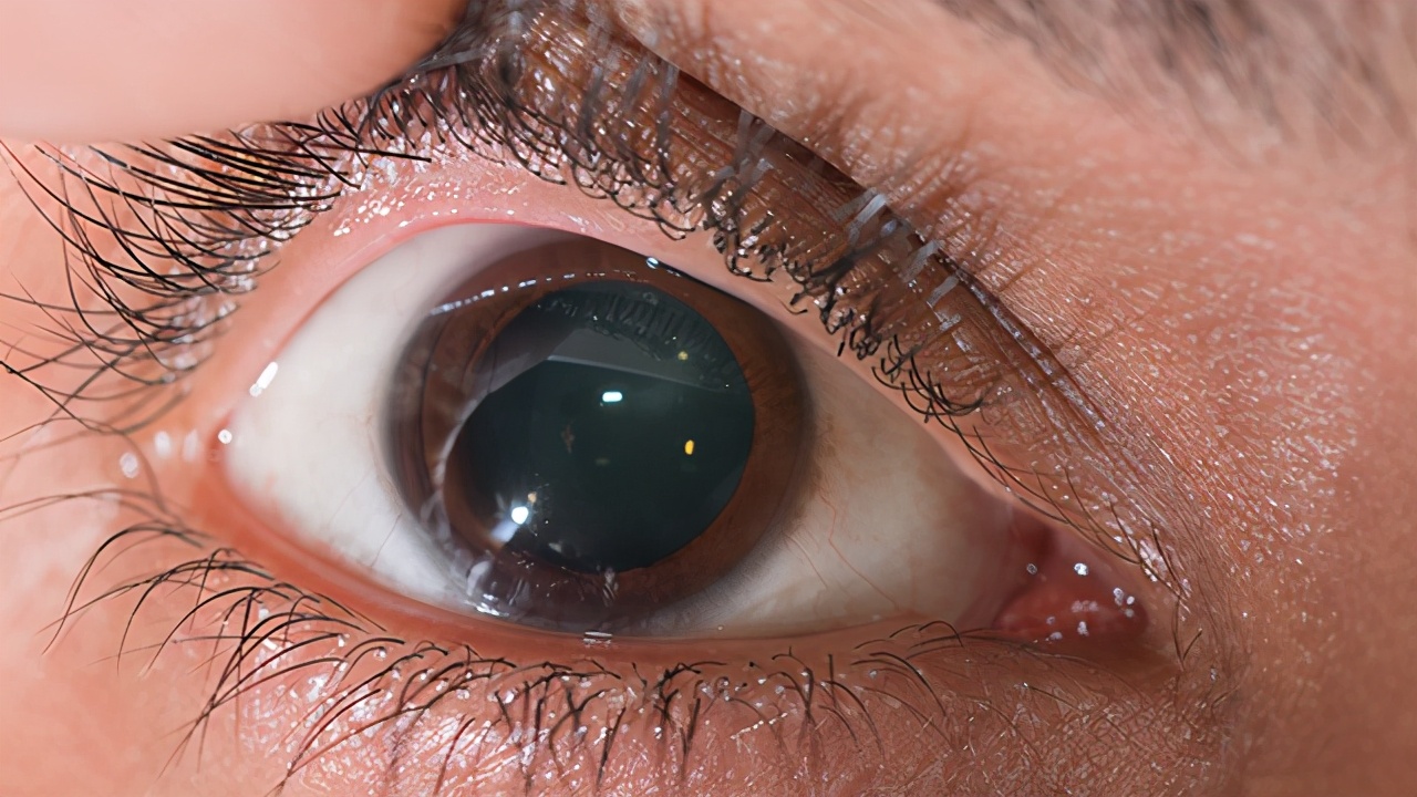 怎样防止眼底黄斑病变,如何简单判断眼底黄斑