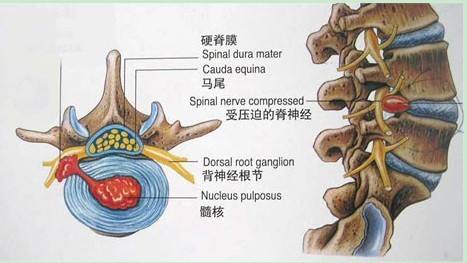 椎间盘突出痛苦,慢性腰椎间盘突出