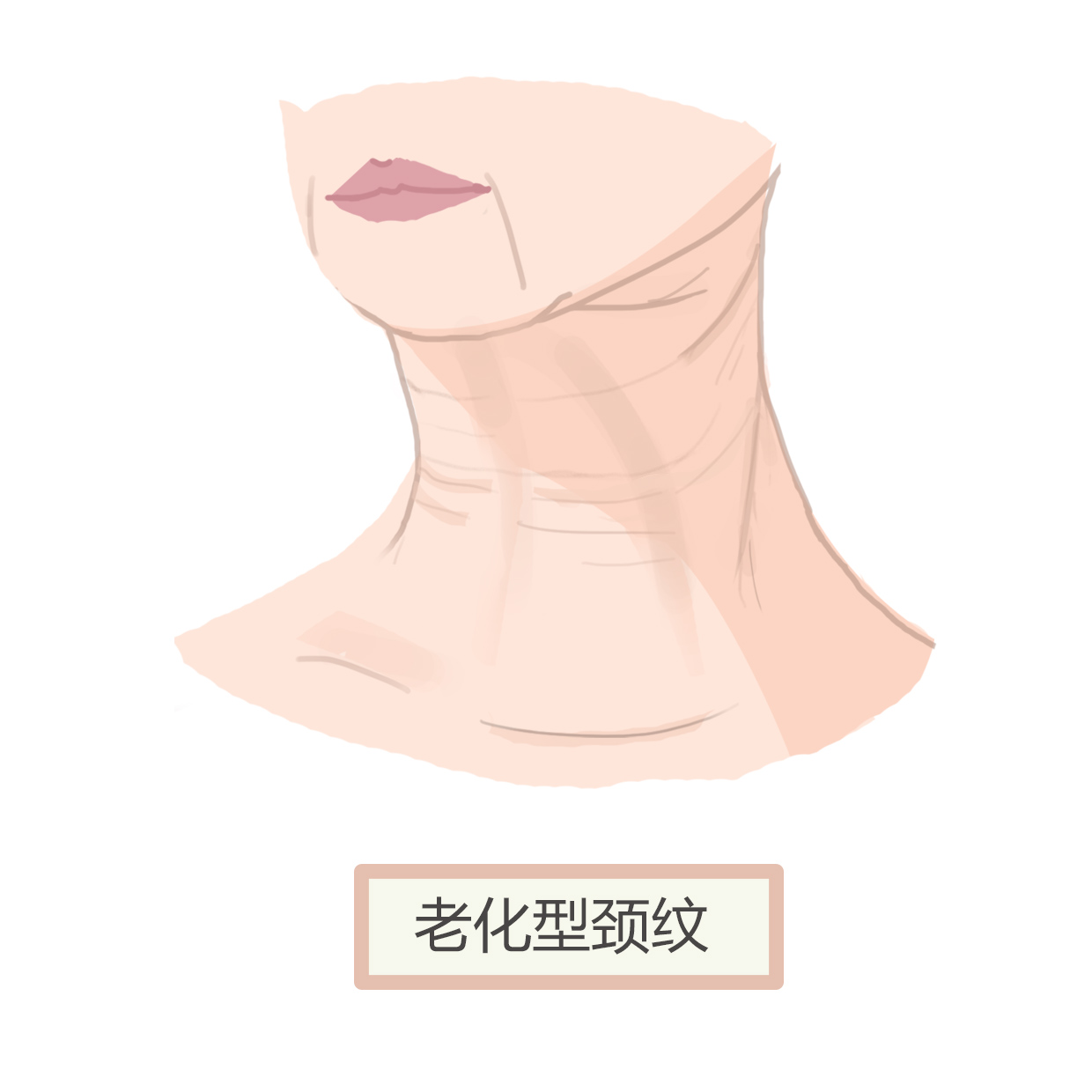 30脸上开始长细纹了怎么办,脸上下垂细纹松弛