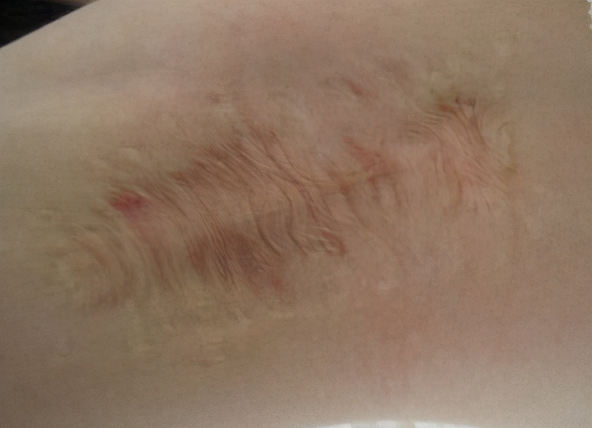 引起狐臭的真正原因到底是什么,狐臭是什么特征引起的怎么治疗