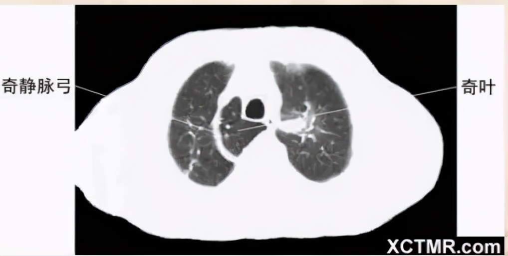 女性盆腔ct断层解剖结构图,女性盆腔脏器ct解剖