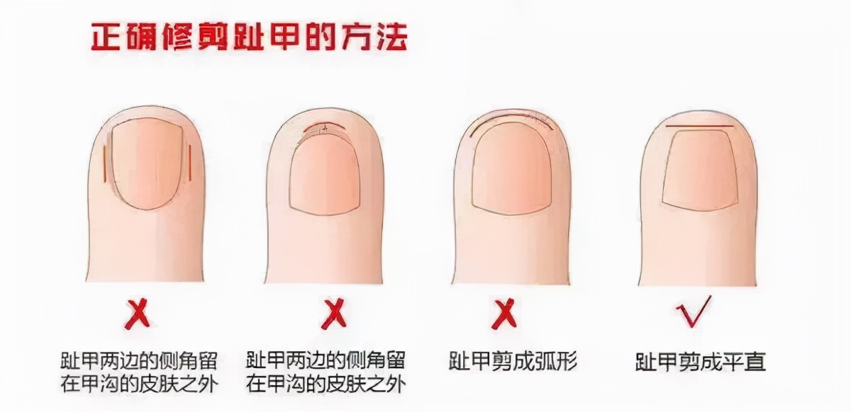 大脚趾头甲沟炎嵌甲钻心的痛,急性手指甲沟炎钻心疼痛