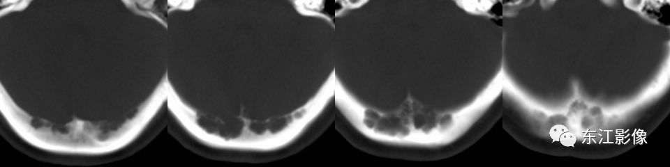 头颅mri扫描影像哪里找,头颅影像mra详细解说