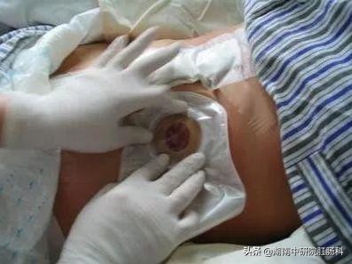 造口患者日常生活护理宣教,造口病人夏季护理