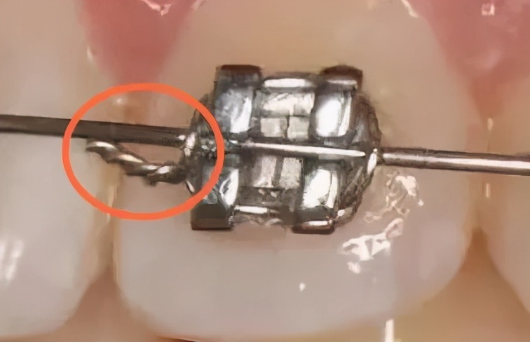 什么情况需要牙齿矫正一般多少钱,为什么去医院矫正牙齿每次都收费