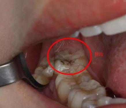 智齿引发的冠周炎多久可以拔牙,智齿引发的冠周炎是什么症状