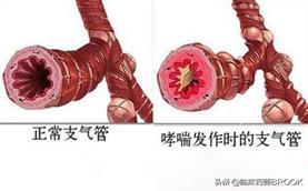 哮喘患者如何正确使用吸入剂,哮喘用吸入剂还是孟鲁司特