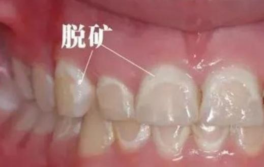 用完牙贴牙齿出现了白斑怎么回事,牙齿出现白斑要注意补钙还是防蛀