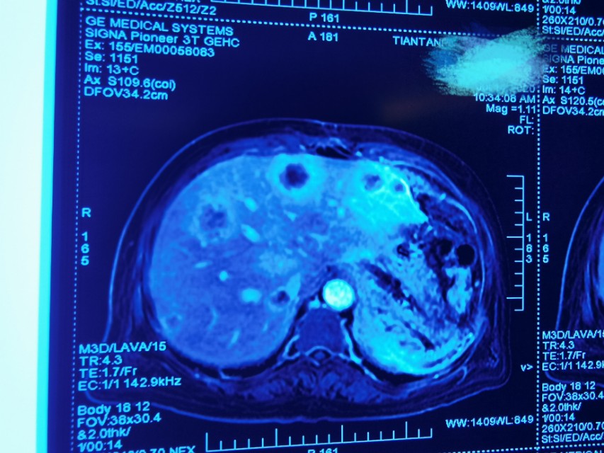 胰腺癌腹膜后多发淋巴转移严重吗,胰腺癌肝内多发转移可以放疗吗