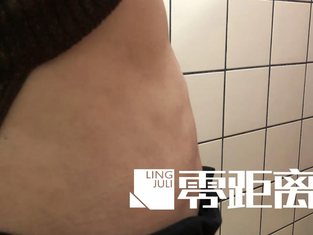 女子抽脂手术后凹凸不平,女子吸脂失败导致大腿凹凸不平