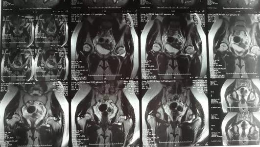 小朋友跳多了晚上就会腿疼,小孩走路跑跳的时候膝盖疼