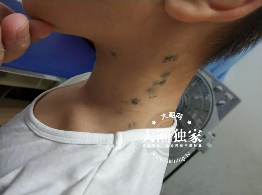 十岁小孩身上被扎12针,触目惊心的少年