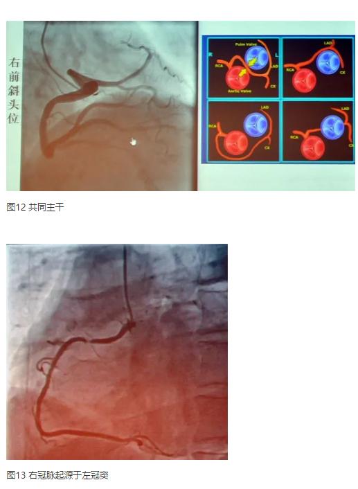 清晰完整揭秘冠脉造影全部过程,冠脉造影教学视频