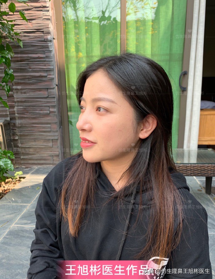 手术鼻头增厚能用什么方法弄,大鼻头高鼻梁缩小手术案例