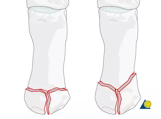 几种严重骨折医学名称,常见的骨折有哪些名称