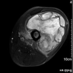 菁讲:你所不知道的横纹肌肉瘤