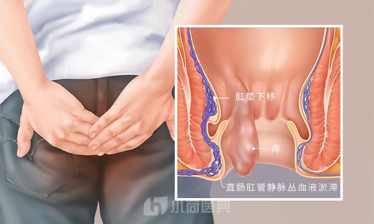 外痔手术的操作流程示意图,外痔位置
