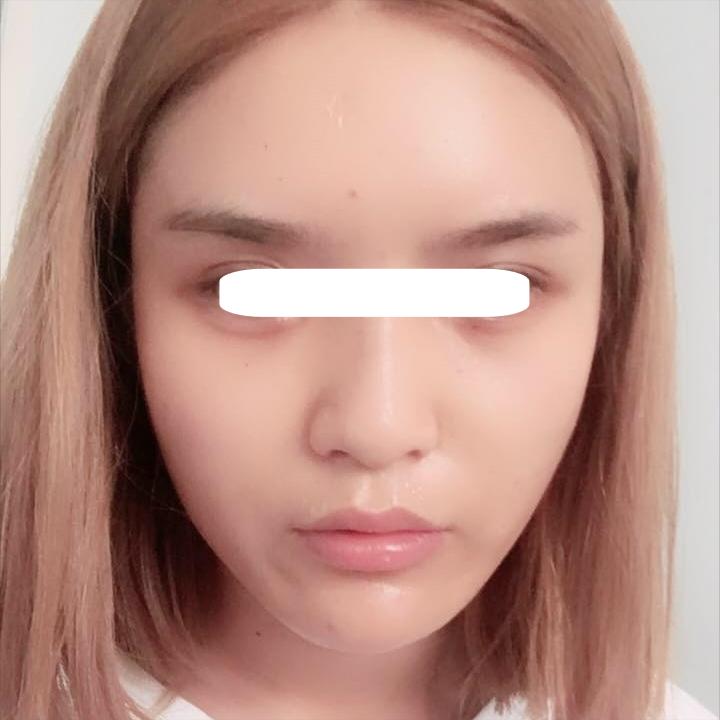 明星为啥要做脂肪填充鼻子,为什么明星喜欢整容