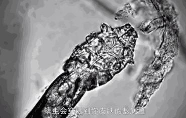 头皮一直出汗痒,头皮多痒出油掉发严重怎么办