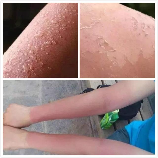 军训晒黑晚上用什么修复,军训晒后修护白天