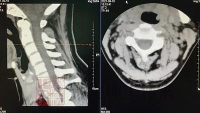 颈椎病的六种分型及专科检查,正骨治颈椎病需要几次