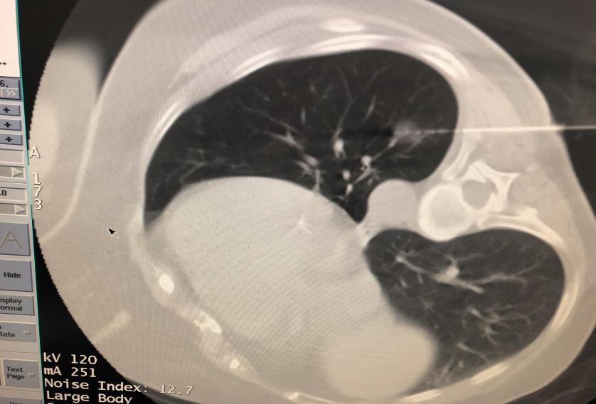 聊城退役军人医院能做手术吗,聊城市人民医院可以做射频消融术