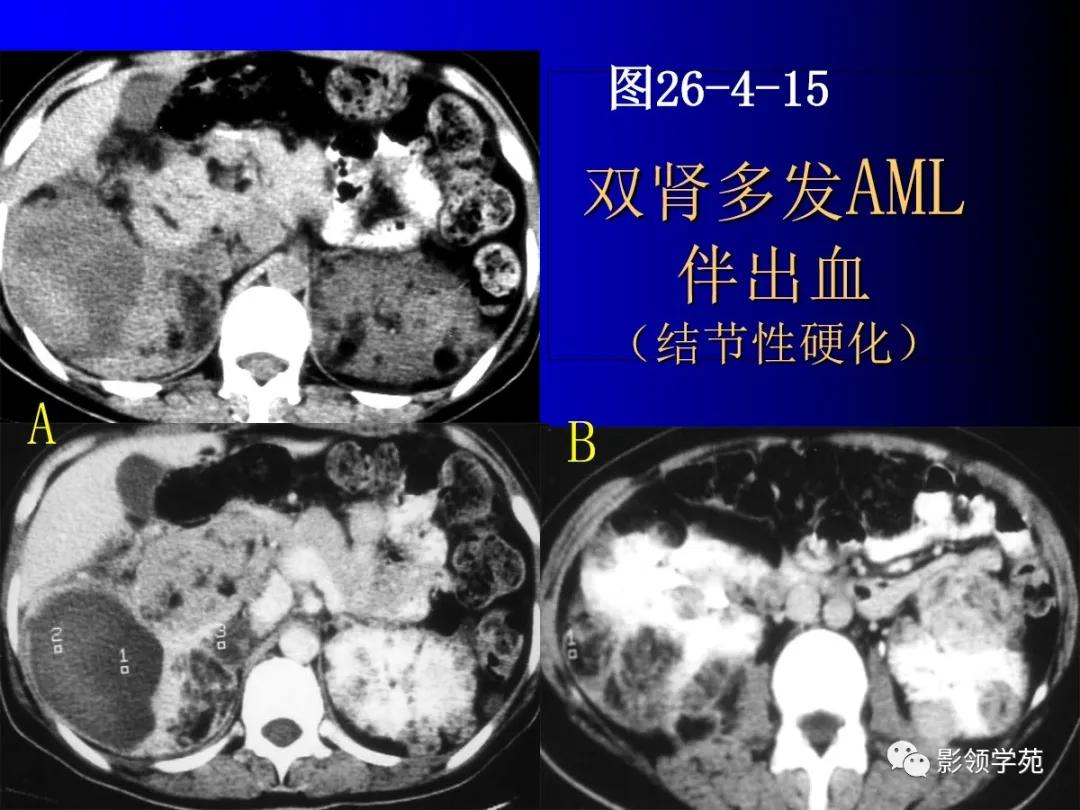 肾脏囊性肿块的影像学特点,肾脏典型病理图片及解析