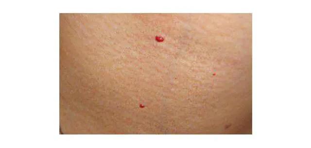 乙肝患者皮肤发黄还意味着什么,乙肝患者皮肤出现红点