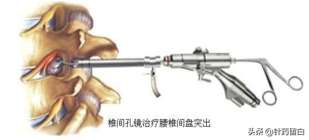 一文读懂靶向治疗,一文看懂椎体成形