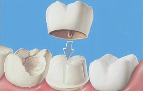 烤瓷牙安装后出现根尖周炎,烤瓷牙牙龈萎缩露黑边可以修复吗