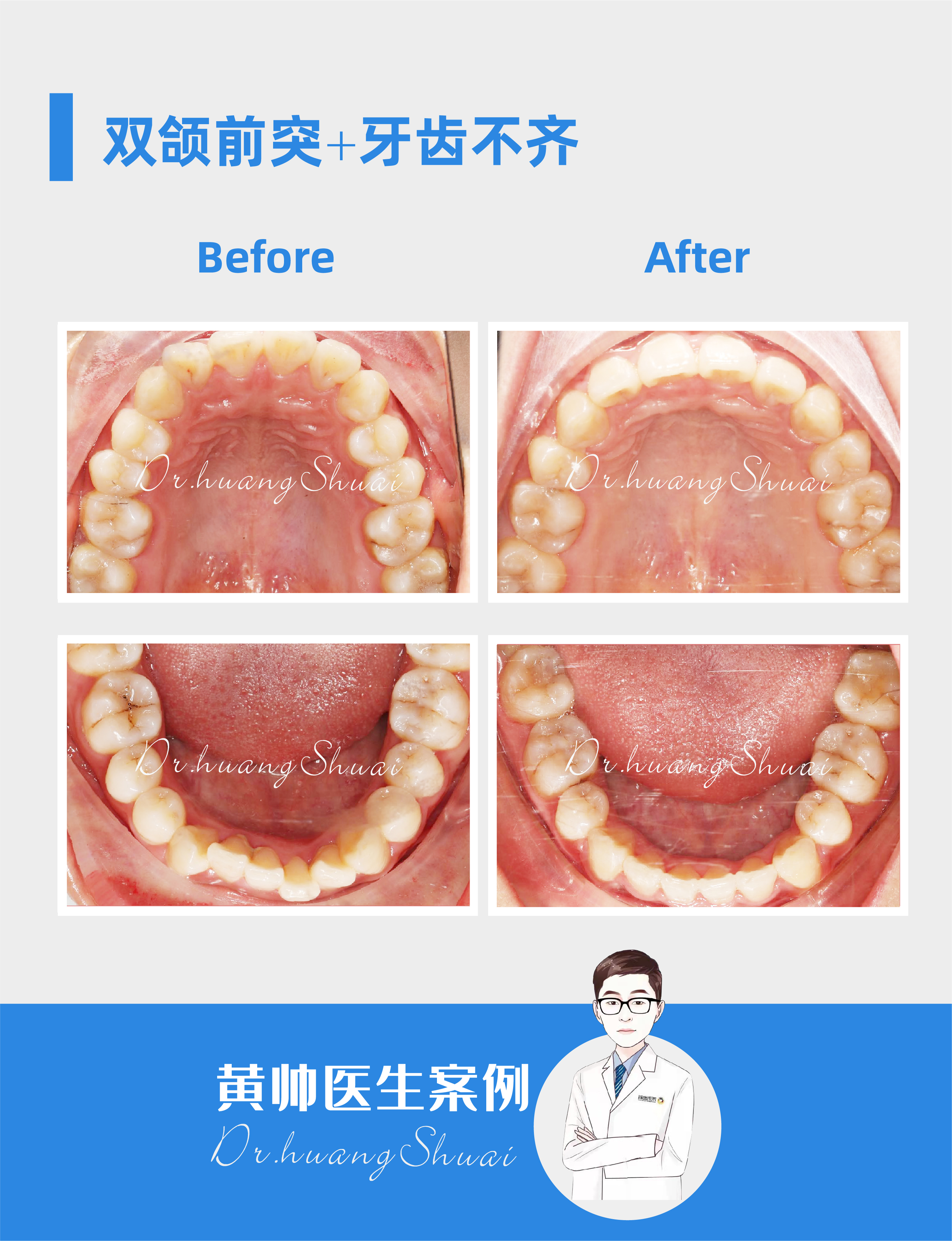 嘴凸牙齿矫正前后对比视频,牙齿矫正拔智齿可以怎样改善嘴凸