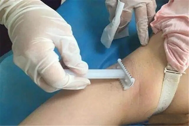 剖宫产真的比顺产好吗,剖宫产全过程解析