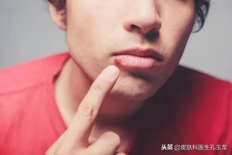 嘴唇长疱疹是哪里上火了,嘴唇上火起泡和单纯疱疹怎么区别