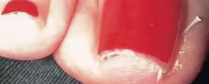 治疗甲沟炎真正有效的办法,甲沟炎指甲剪神器正品