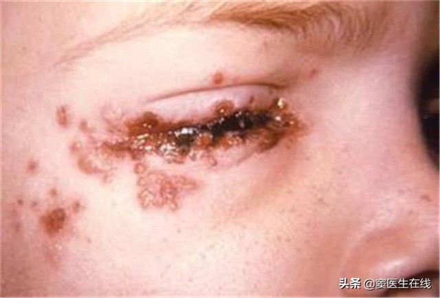 儿童单纯疱疹的危害,单纯疱疹会影响孩子么